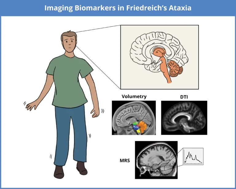 फ्रेडरिक अटाक्सिया (Friedreich's Ataxia - तंत्रिका तंत्र की क्षति)
