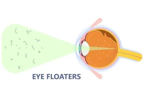 फ्लोटर्स और फ्लैशेस (Floaters and Flashes - आंखों के सामने जाले या रोशनी चमकना)