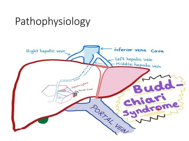 बड-चियारी सिंड्रोम (Budd-Chiari Syndrome - लिवर की नसों में रुकावट)