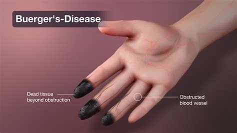 बर्गर रोग (Buerger's Disease / Thromboangiitis Obliterans)