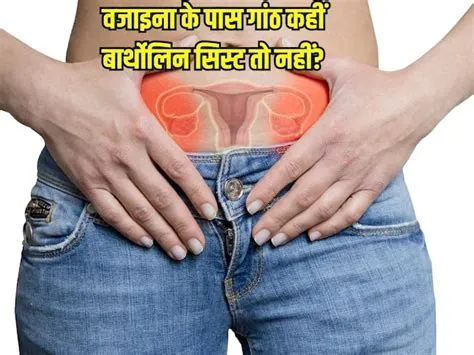 बार्थोलिन सिस्ट (Bartholin's Cyst)