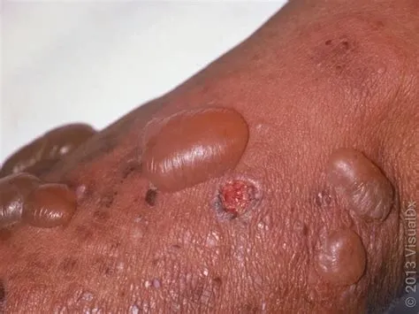 बुलोस पेम्फिगॉइड (Bullous Pemphigoid - बुजुर्गों में त्वचा पर छाले)