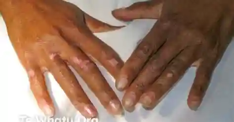 बेहेसेट रोग (Behçe s Disease - रक्त वाहिकाओं की सूजन)