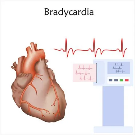 ब्रैडीकार्डिया (Bradycardia - धीमी हृदय गति)
