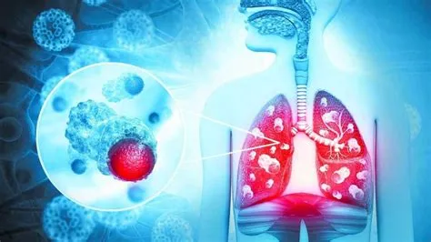 ब्रोंकिएक्टेसिस (Bronchiectasis - श्वासनली का स्थायी फैलाव और संक्रमण)