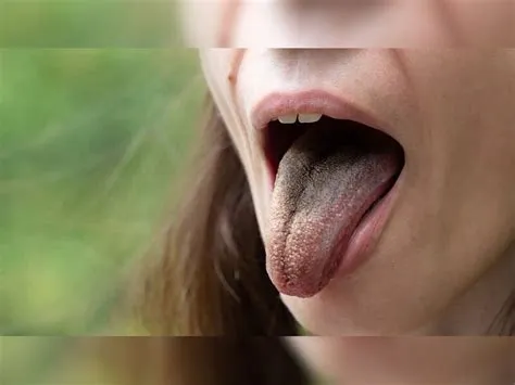ब्लैक हेयरी टंग (Black Hairy Tongue - जीभ का काला और बालों जैसा दिखना)