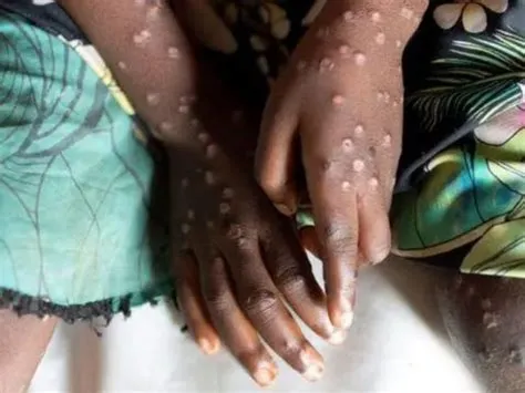 मंकीपॉक्स (Mpox / Monkeypox)