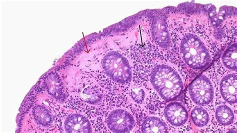 माइक्रोस्कोपिक कोलाइटिस (Microscopic Colitis)