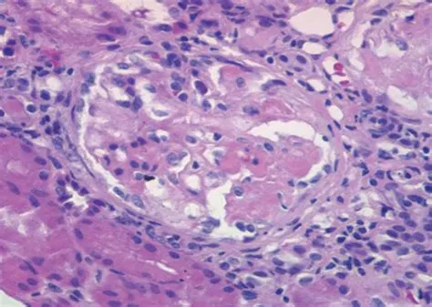 माइक्रोस्कोपिक पॉलीएंगाइटिस (Microscopic Polyangiitis)