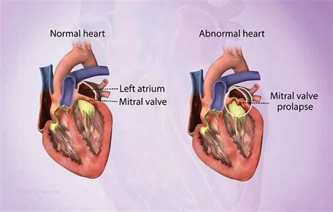 माइट्रल वाल्व प्रोलैप्स (Mitral Valve Prolapse)