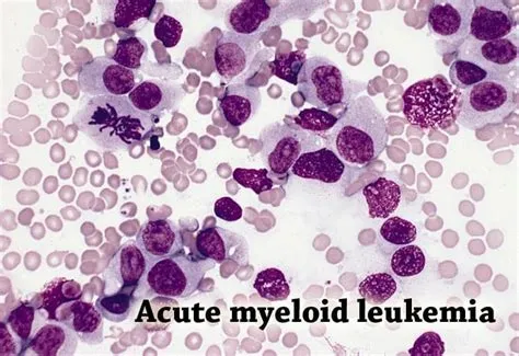 मायलोइड ल्यूकेमिया (Myeloid Leukemia)