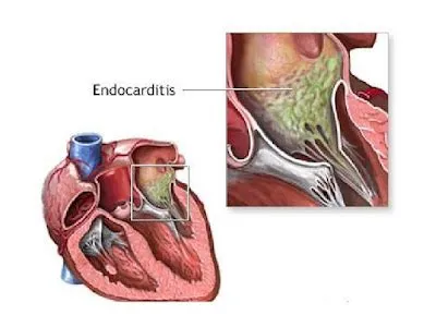मायोकार्डिटिस (Myocarditis - हृदय की मांसपेशियों की सूजन)