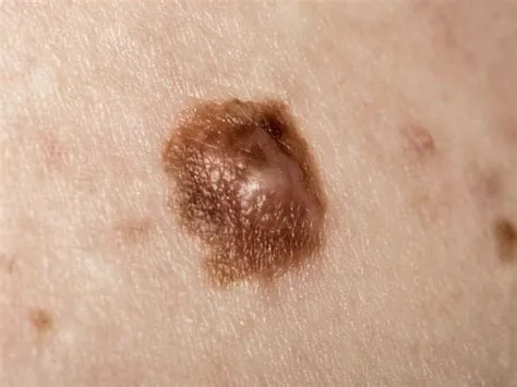 मेलेनोमा स्किन कैंसर (Melanoma Skin Cancer)