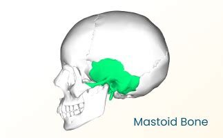 मैस्टॉयडाइटिस (Mastoiditis - कान के पीछे की हड्डी का संक्रमण)