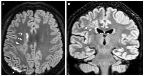 मोयामोया रोग (Moyamoya Disease - मस्तिष्क की धमनियों का सिकुड़ना)