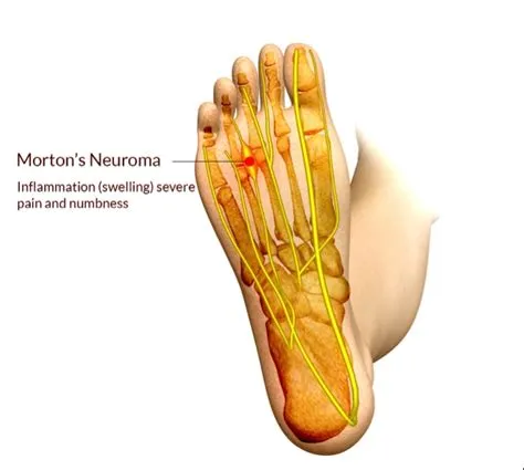 मोर्टन न्यूरोमा (Morton's Neuroma - पैर की उंगलियों की नसों में सूजन)