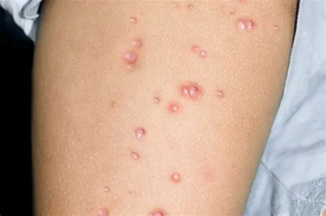 मोल्लुस्कम कॉन्टेजियोसम (Molluscum Contagiosum - त्वचा के वायरल मस्से)