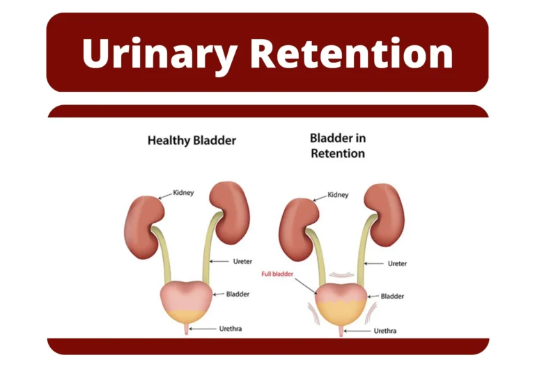 यूरिनरी रिटेंशन (Urinary Retention - पेशाब का रुक जाना)