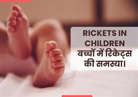 रिकेट्स (Rickets - विटामिन डी की कमी से बच्चों में हड्डियों का मुड़ना)