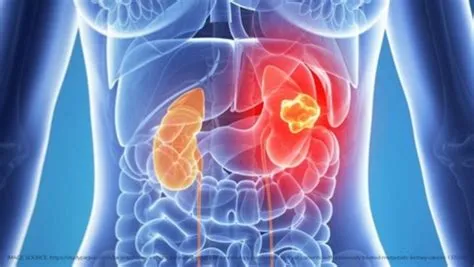 रीनल पेल्विक कैंसर (Renal Pelvic Cancer)