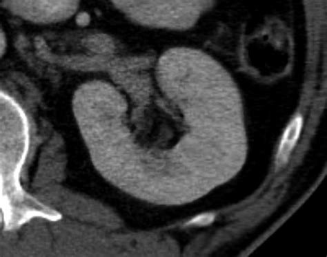 रीनल पैपिलरी नेक्रोसिस (Renal Papillary Necrosis - किडनी के टिशू का नष्ट होना)