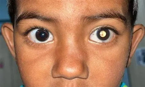 रेटिनोब्लास्टोमा (Retinoblastoma - आंखों का कैंसर)