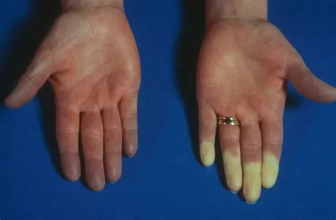 रेनॉड सिंड्रोम (Raynaud's Phenomenon - ठंड में उंगलियों का सुन्न और नीला पड़ना)