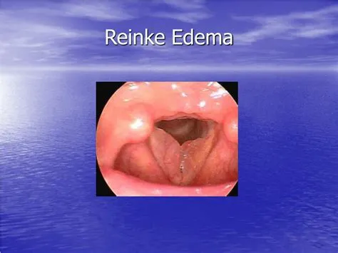 रेन्केस एडिमा (Reinke's Edema - वोकल कॉर्ड में तरल पदार्थ जमा होना)