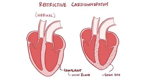 रेस्ट्रिक्टिव कार्डियोमायोपैथी (Restrictive Cardiomyopathy)