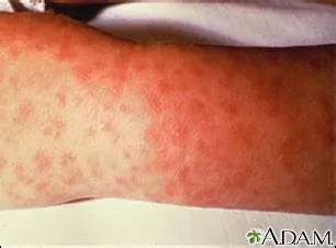 रॉकी माउंटेन स्पॉटेड फीवर (Rocky Mountain Spotted Fever)