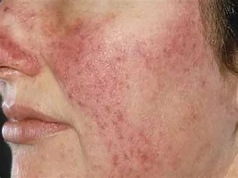 रोजेशिया (Rosacea)