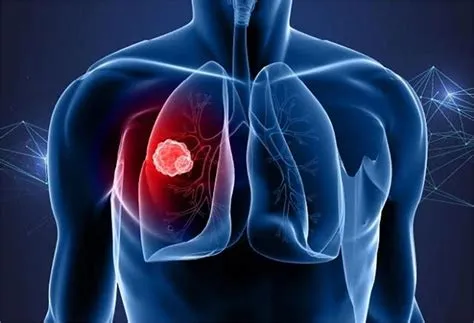 लंग मेसोथेलियोमा (Mesothelioma - फेफड़ों की परत का कैंसर)