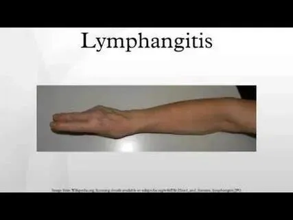 लिम्फैंगाइटिस (Lymphangitis - लसीका वाहिकाओं का संक्रमण)