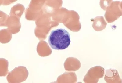 वाल्डनस्ट्रॉम मैक्रोग्लोबुलिनेमिया (Waldenstrom Macroglobulinemia - रक्त का कैंसर)