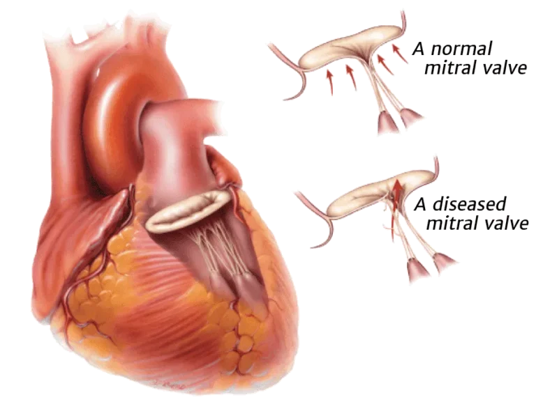 वाल्वुलर हार्ट डिजीज (Valvular Heart Disease - माइट्रल/एओर्टिक वाल्व रोग)