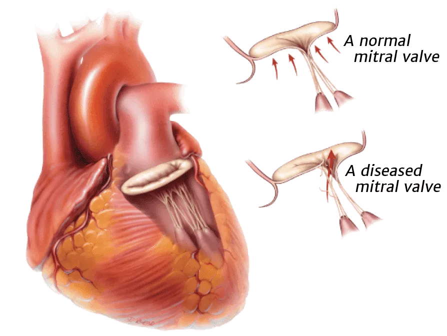 वाल्वुलर हार्ट डिजीज (Valvular Heart Disease - माइट्रल/एओर्टिक वाल्व रोग)