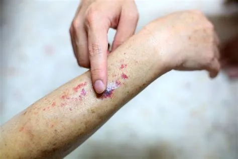 वास्कुलाइटिस (Vasculitis - रक्त वाहिकाओं की सूजन)