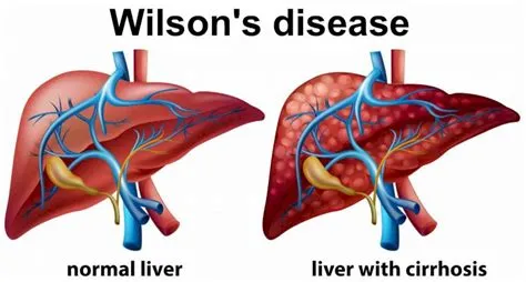 विल्सन रोग (Wilson Disease - लिवर और मस्तिष्क में कॉपर जमा होना)