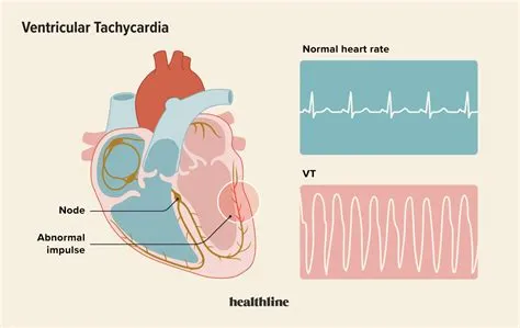 वेंट्रिकुलर टैकीकार्डिया (Ventricular Tachycardia)