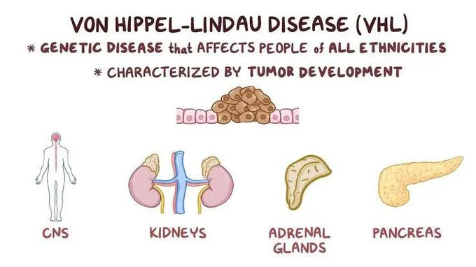 वॉन हिप्पेल-लिंडौ रोग (Von Hippel-Lindau Disease)