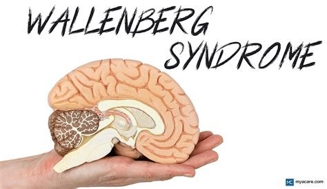 वॉलेंबर्ग सिंड्रोम (Wallenberg Syndrome)