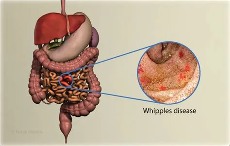 व्हिपल रोग (Whipple's Disease - एक दुर्लभ बैक्टीरियल संक्रमण)