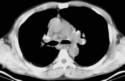 सारकॉइडोसिस (Sarcoidosis - अंगों में सूजन की गांठें)