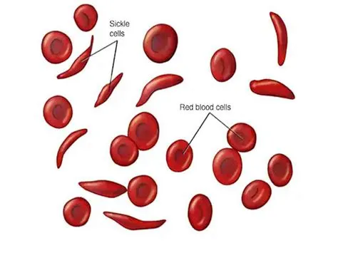सिकल सेल ट्रेट (Sickle Cell Trait)