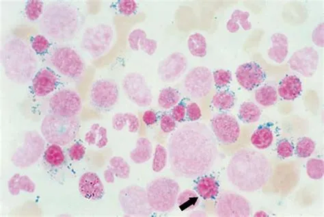 सिडरोब्लास्टिक एनीमिया (Sideroblastic Anemia)