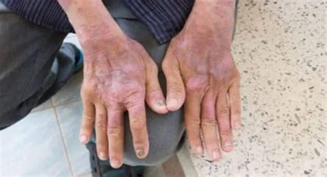सिस्टमिक स्केलेरोसिस / स्क्लेरोडर्मा (Scleroderma - त्वचा और अंगों का सख्त होना)