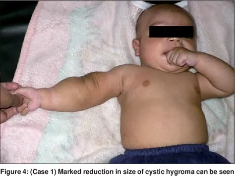 सिस्टिक हाइग्रोमा (Cystic Hygroma)