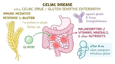सीलिएक स्प्रू (Celiac Sprue - ग्लूटेन एलर्जी का उग्र रूप)