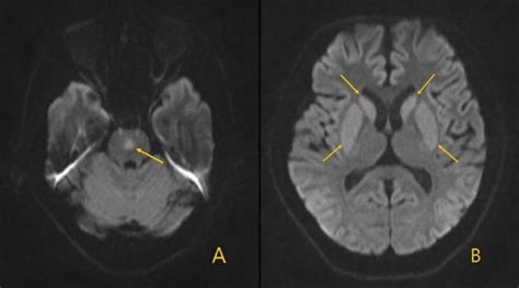 सेंट्रल पोंटीन मायलिनोलिसिस (Central Pontine Myelinolysis)