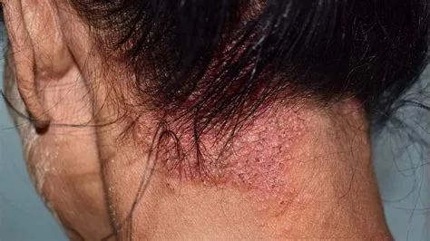 सेबोरहाइक डर्मेटाइटिस (Seborrheic Dermatitis - रूसी और पपड़ीदार त्वचा)